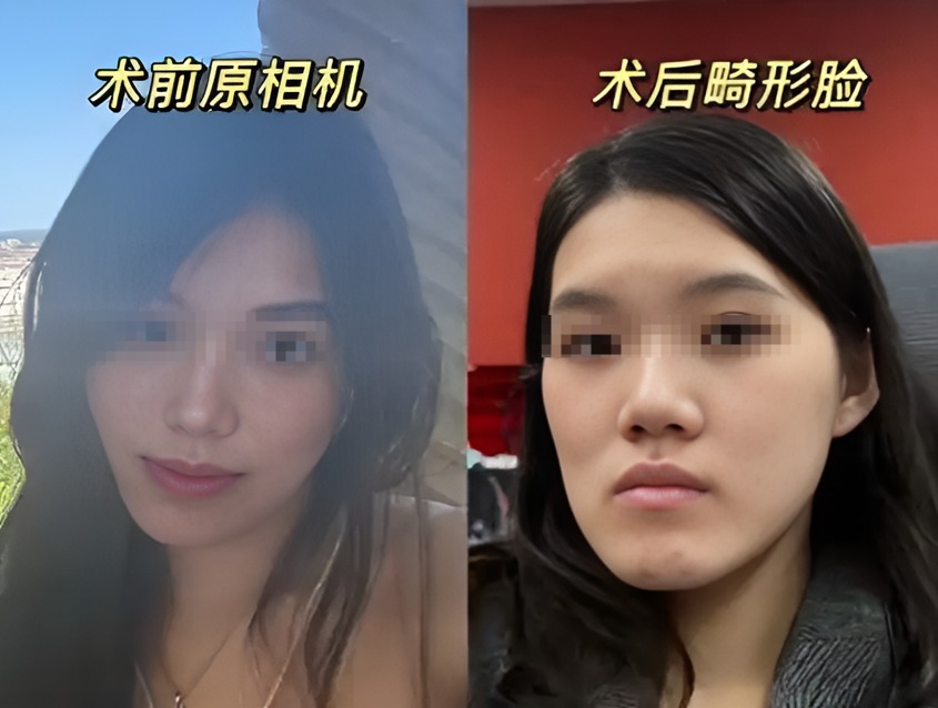 正颌手术被做反舆情复盘：轻微地包天变“鞋拔子脸”，24岁女孩的遭遇如何引爆全网愤怒